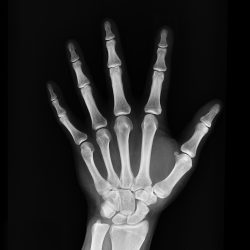 x-ray, medical treatment, arm-1704855.jpg